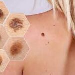 Debunking Skin Cancer Myths